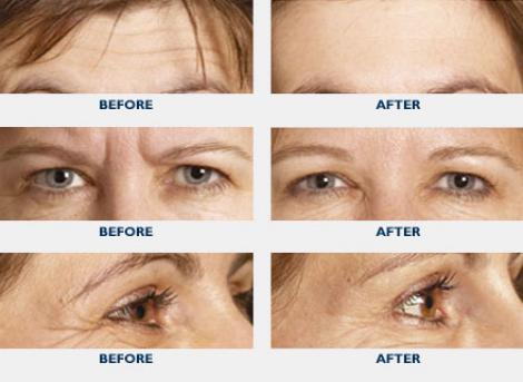 Image result for botox injections