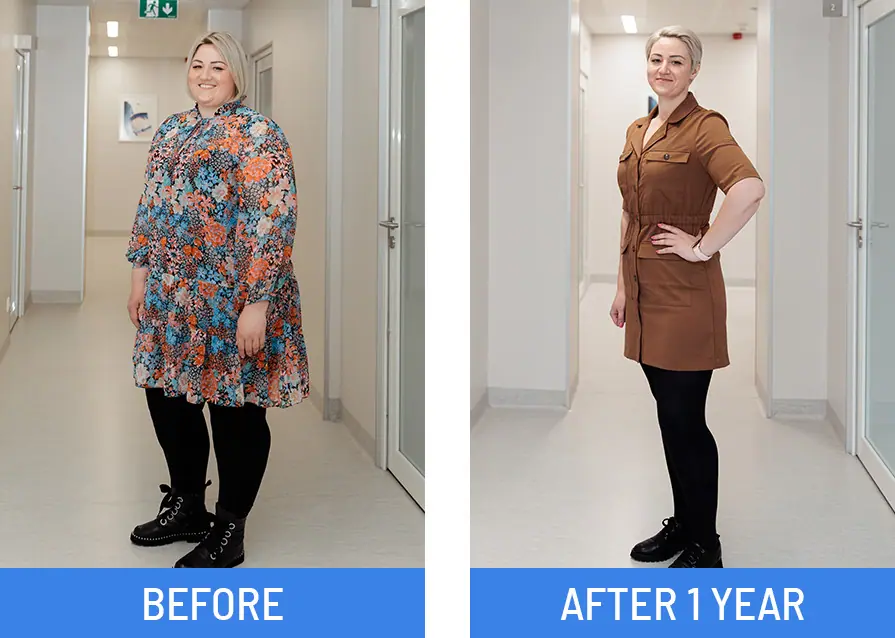 Before and after gastric sleeve by Donatas Danys