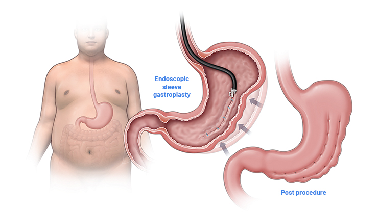 Endoscopic sleeve gastroplasty explained Endoscopic sleeve gastroplasty explained