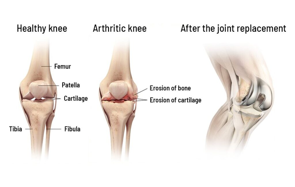 Healthy knee arthritic knee after the joint replacement Healthy knee arthritic knee after the joint replacement